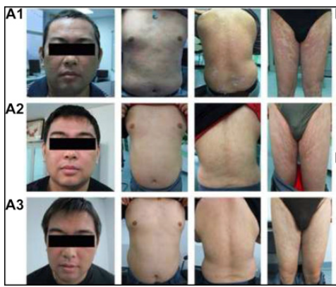 患者一治療前后的對比圖