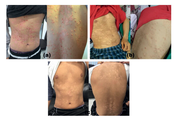 G-MSC 輸注對患有 5 年嚴重斑塊性銀屑病的 19 歲男性的影響。