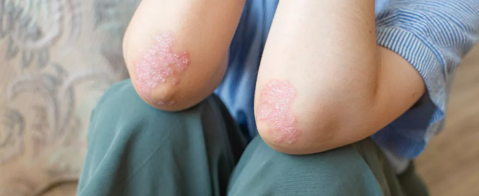 干細胞治療銀屑病：如何實現從短期銀屑病面積減少到長期皮膚恢復正常？