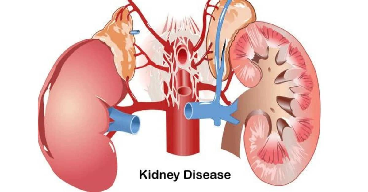 干細(xì)胞治療腎病：靜脈、動(dòng)脈、皮質(zhì)注射哪種更安全
