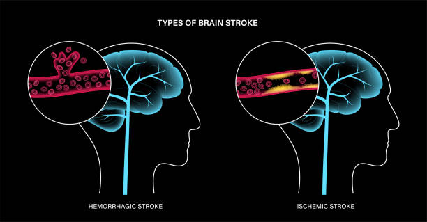 從癱瘓到復健！神經干細胞療法5大機制如何促進中風后的大腦修復？