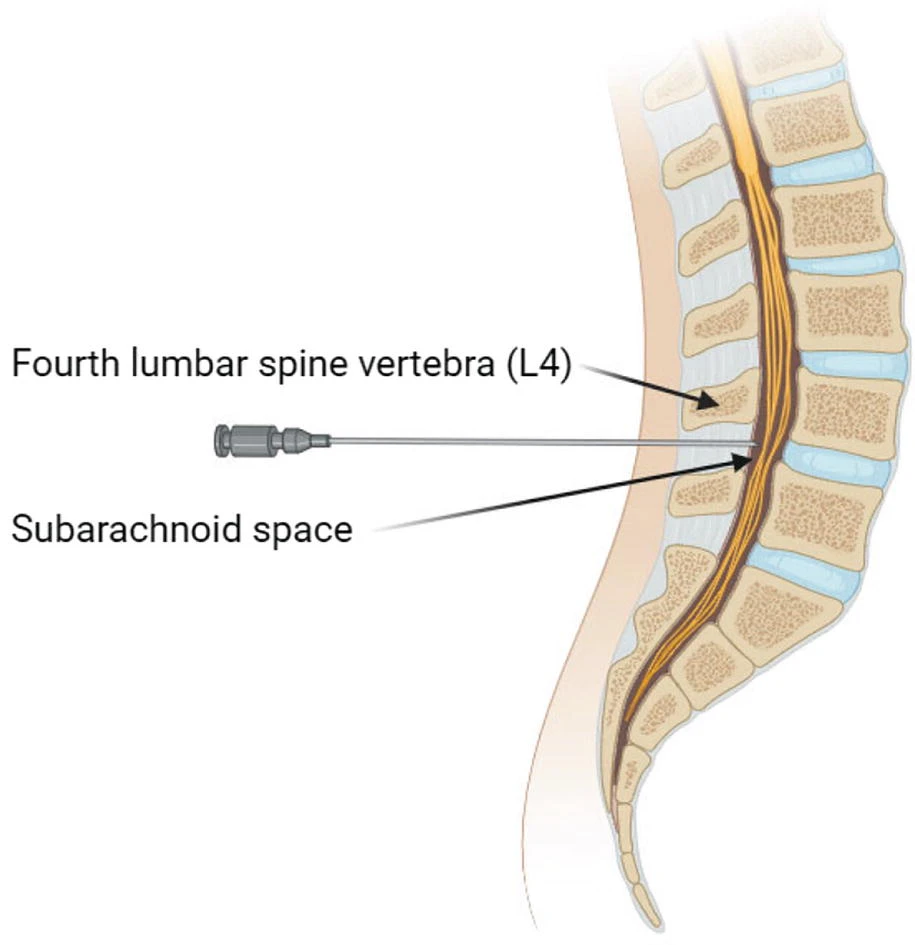 鞘內(nèi)細(xì)胞輸注 鞘內(nèi)細(xì)胞輸注