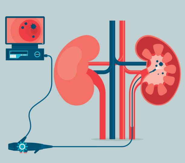 2025糖尿病腎病的5種最新治療方法指南(截至10月) 2025糖尿病腎病的5種最新治療方法指南(截至10月)