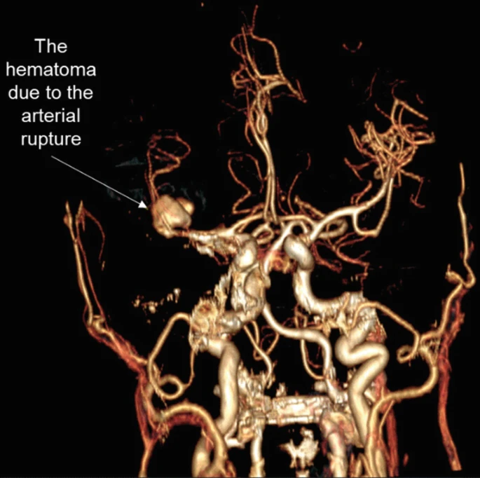 圖2：出血導致中風