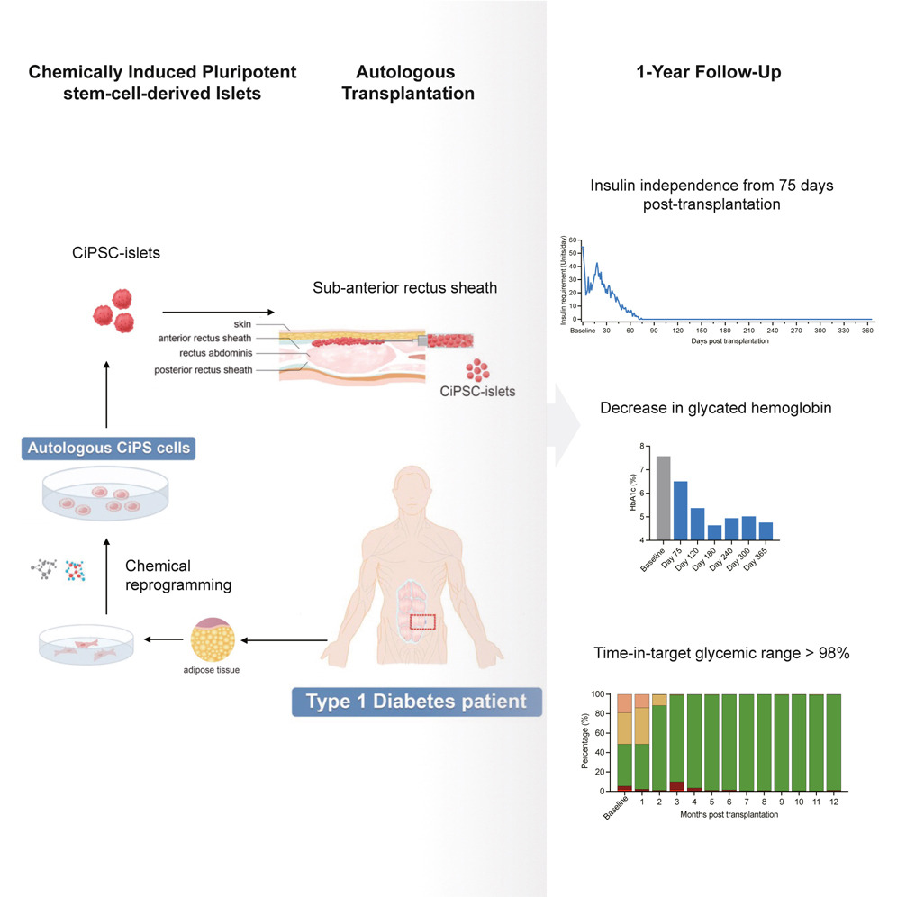 化學誘導多能干細胞衍生的胰島自體移植一年隨訪