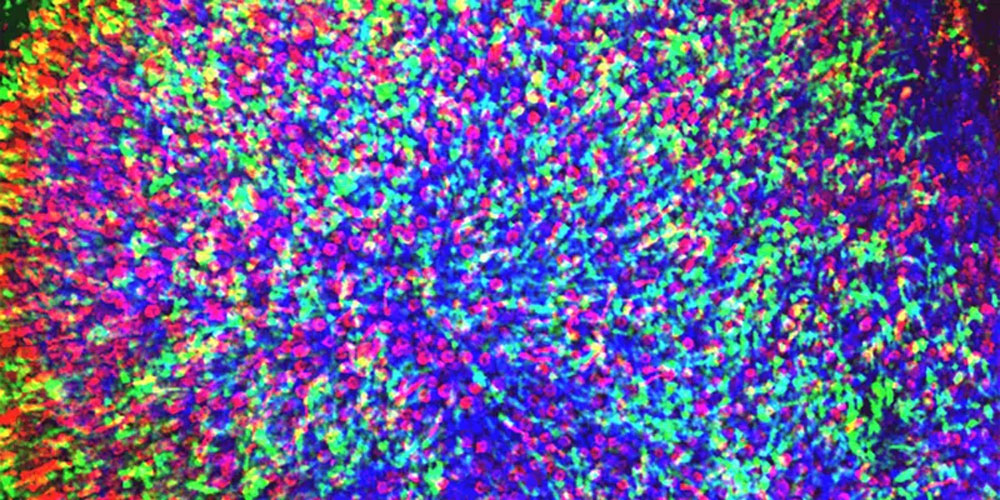 視網(wǎng)膜色素變性