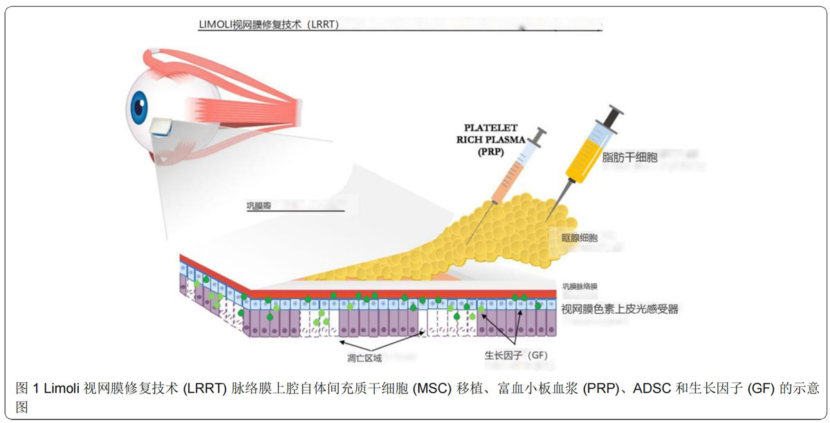 青光眼臨床試驗(yàn)