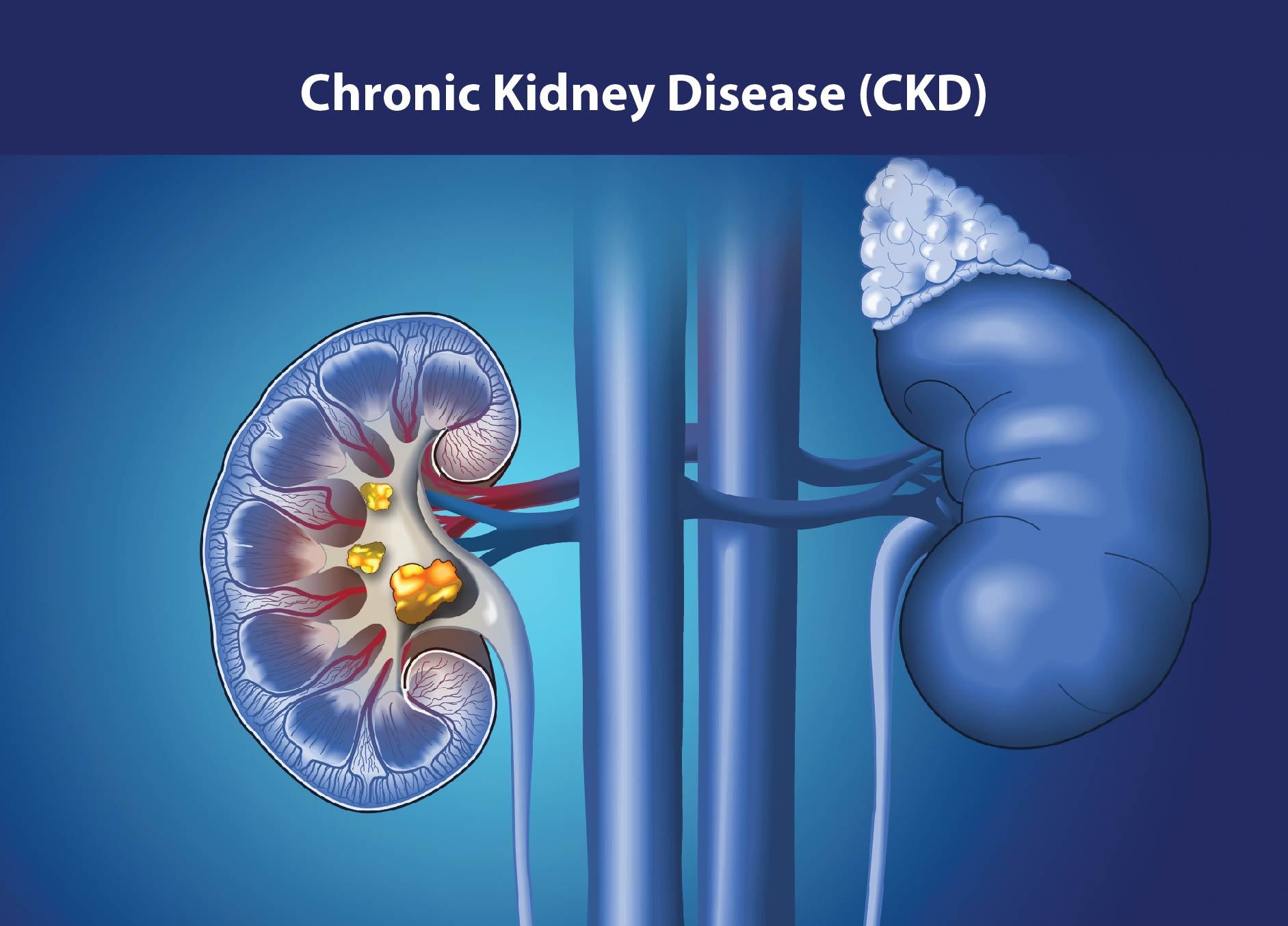 慢性腎病治療新策略:間充質(zhì)干細(xì)胞如何修復(fù)腎功能、延緩疾病進(jìn)展? 慢性腎病治療新策略:間充質(zhì)干細(xì)胞如何修復(fù)腎功能、延緩疾病進(jìn)展?