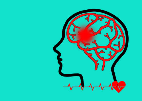 哪些中風患者適合干細胞治療?專家公布了5大評估標準 哪些中風患者適合干細胞治療?專家公布了5大評估標準