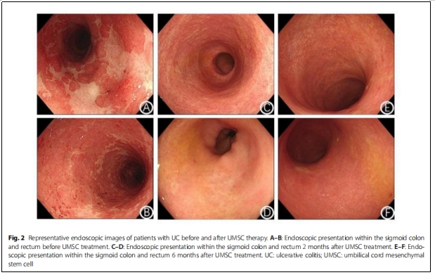 圖2:潰瘍性結(jié)腸炎患者接受UMSC治療前后內(nèi)鏡檢查的典型圖像 圖2:潰瘍性結(jié)腸炎患者接受UMSC治療前后內(nèi)鏡檢查的典型圖像