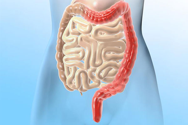 潰瘍性結(jié)腸炎新希望:干細(xì)胞移植2個(gè)月緩解率達(dá)7成,4成患者實(shí)現(xiàn)粘膜愈合 潰瘍性結(jié)腸炎新希望:干細(xì)胞移植2個(gè)月緩解率達(dá)7成,4成患者實(shí)現(xiàn)粘膜愈合