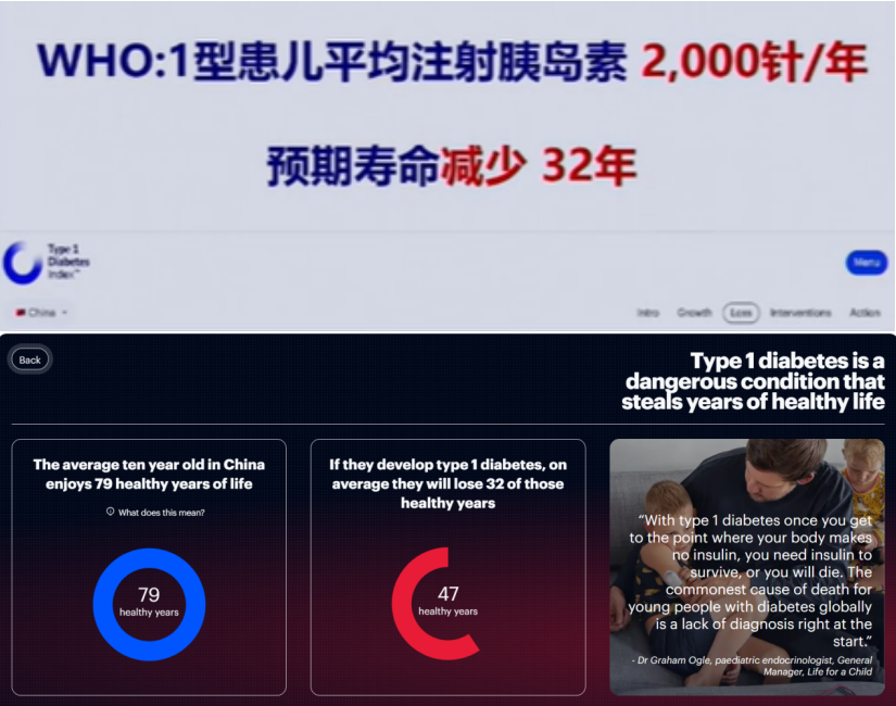 2025｜間充質干細胞療法治療1型糖尿病：現狀與臨床進展