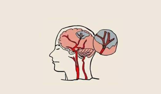 中風后的腦損傷，真的能被干細胞療法逆轉嗎？